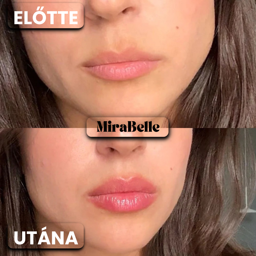 MiraBelle – BotoxLips Szájfény (Fájdalom És Csípő Érzés Nélkül Dúsítja Ajkaid)